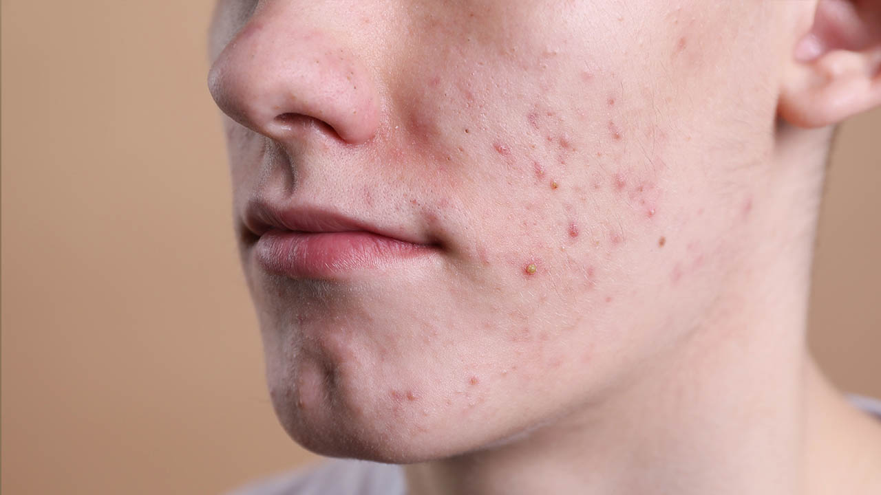 הפתרון היעיל ביותר לאקנה - רואקוטן